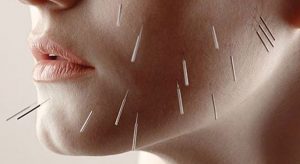 taiyang tratamiento acupuntura facial